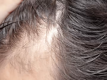 Hair Fall & Dandruff