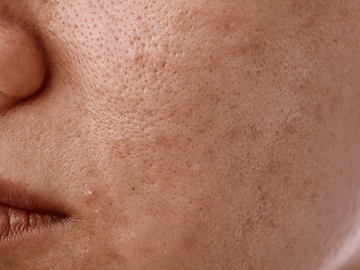 Uneven Skin Tone