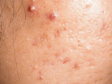 Acne Prone & Oily Skin